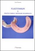 Plastitanium & protesi mobile inferiore bicomposta