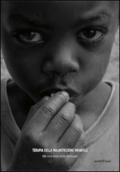 Terapia della malnutrizione infantile. Un contributo dalla Tanzania