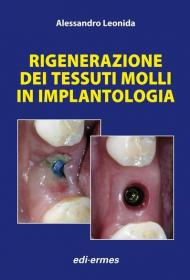 Rigenerazione dei tessuti molli in implantologia