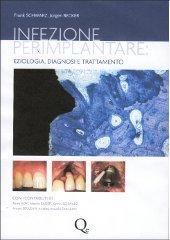 Infezione perimplantare: eziologia, diagnosi e trattamento