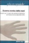 Eczema cronico delle mani. Supporto per immagini alla valutazione diagnostica dell'eczema cronico delle mani