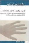 Eczema cronico delle mani. Supporto per immagini alla valutazione diagnostica dell'eczema cronico delle mani